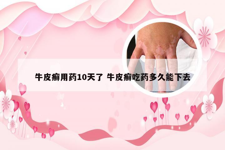 牛皮癣用药10天了 牛皮癣吃药多久能下去