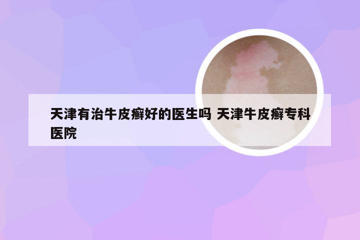 天津有治牛皮癣好的医生吗 天津牛皮癣专科医院