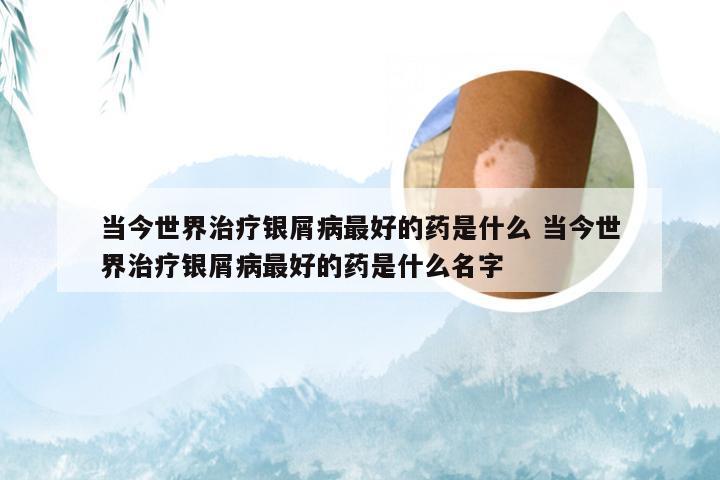 当今世界治疗银屑病最好的药是什么 当今世界治疗银屑病最好的药是什么名字