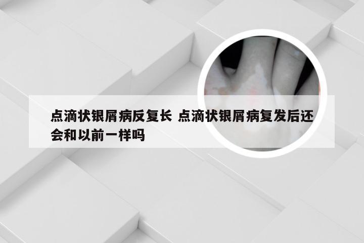 点滴状银屑病反复长 点滴状银屑病复发后还会和以前一样吗