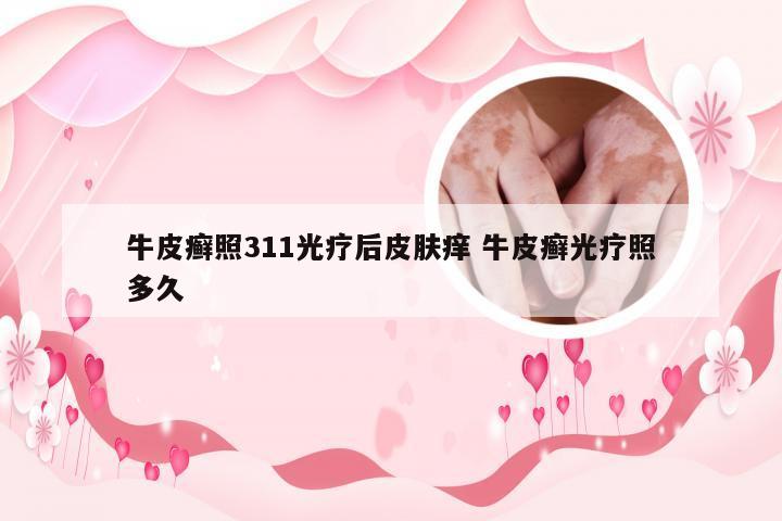 牛皮癣照311光疗后皮肤痒 牛皮癣光疗照多久