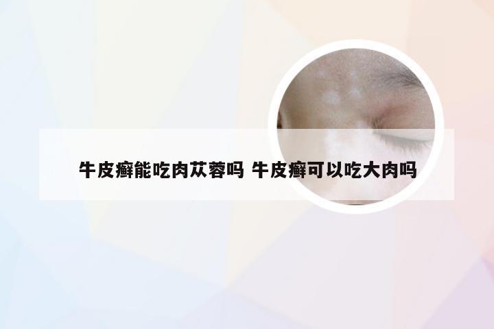 牛皮癣能吃肉苁蓉吗 牛皮癣可以吃大肉吗