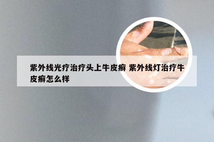 紫外线光疗治疗头上牛皮癣 紫外线灯治疗牛皮癣怎么样