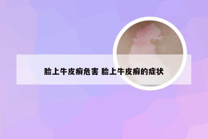 脸上牛皮癣危害 脸上牛皮癣的症状