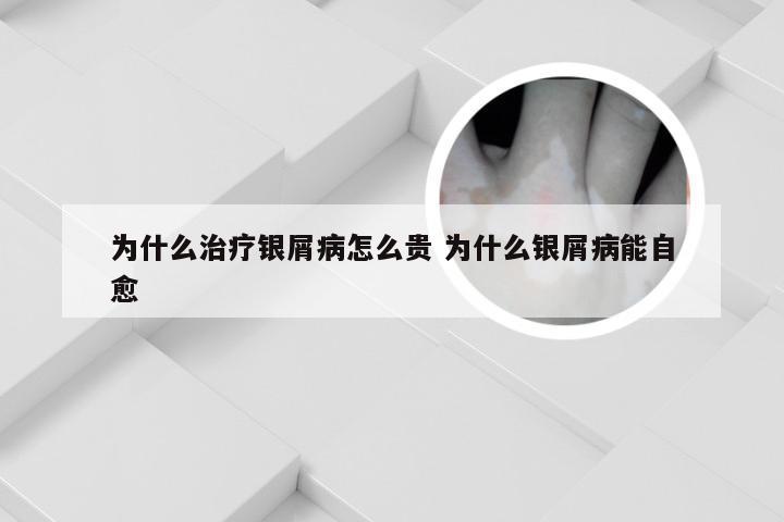 为什么治疗银屑病怎么贵 为什么银屑病能自愈