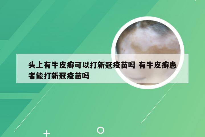头上有牛皮癣可以打新冠疫苗吗 有牛皮癣患者能打新冠疫苗吗