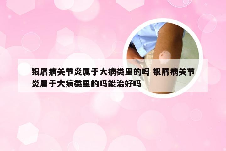 银屑病关节炎属于大病类里的吗 银屑病关节炎属于大病类里的吗能治好吗