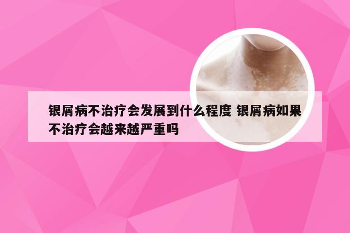 银屑病不治疗会发展到什么程度 银屑病如果不治疗会越来越严重吗