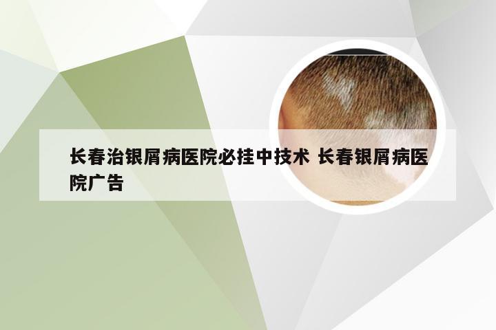 长春治银屑病医院必挂中技术 长春银屑病医院广告
