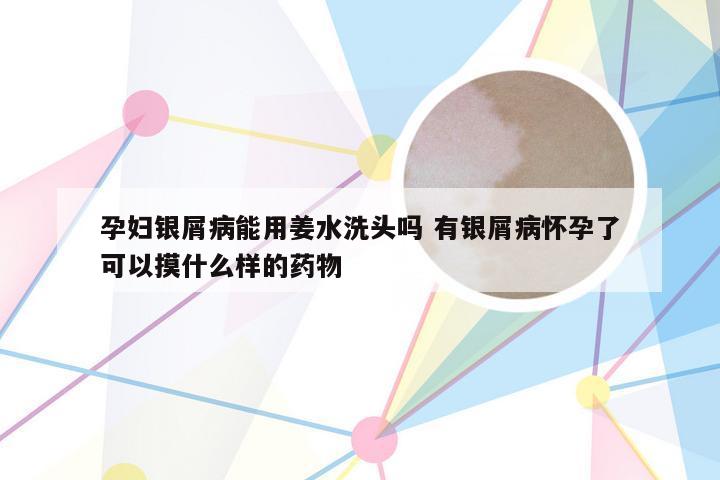 孕妇银屑病能用姜水洗头吗 有银屑病怀孕了可以摸什么样的药物