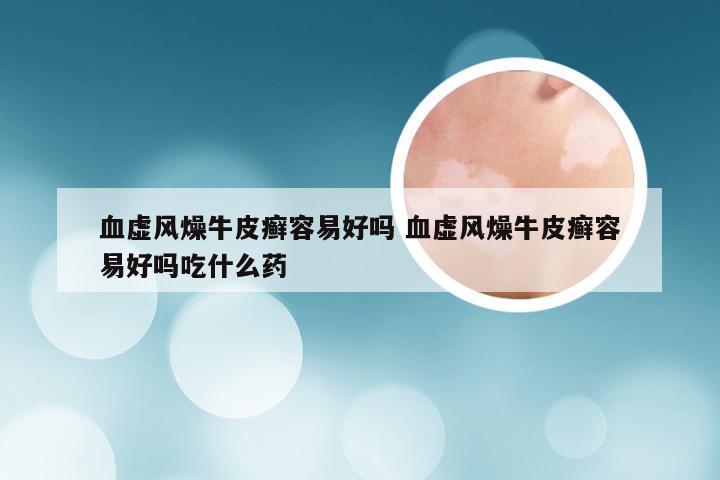 血虚风燥牛皮癣容易好吗 血虚风燥牛皮癣容易好吗吃什么药