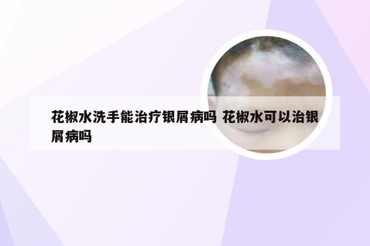 花椒水洗手能治疗银屑病吗 花椒水可以治银屑病吗