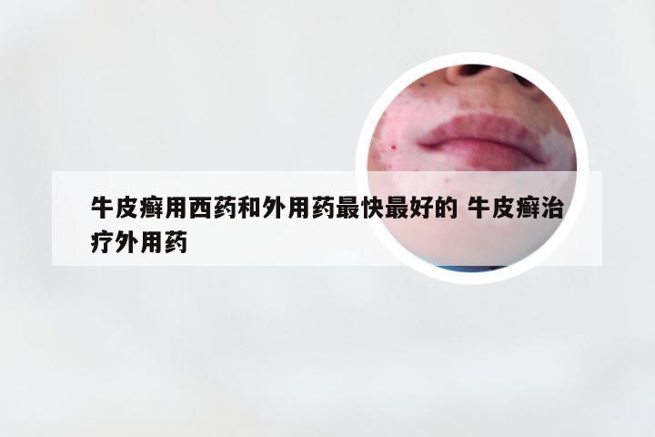 牛皮癣用西药和外用药最快最好的 牛皮癣治疗外用药