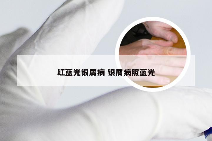 红蓝光银屑病 银屑病照蓝光