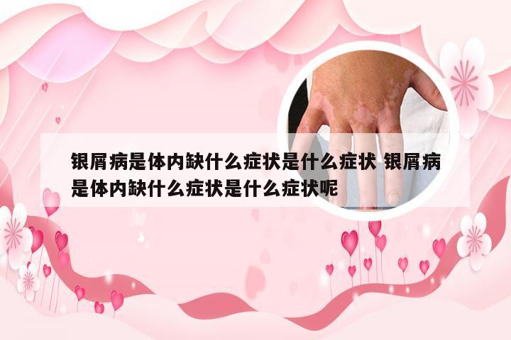 银屑病是体内缺什么症状是什么症状 银屑病是体内缺什么症状是什么症状呢