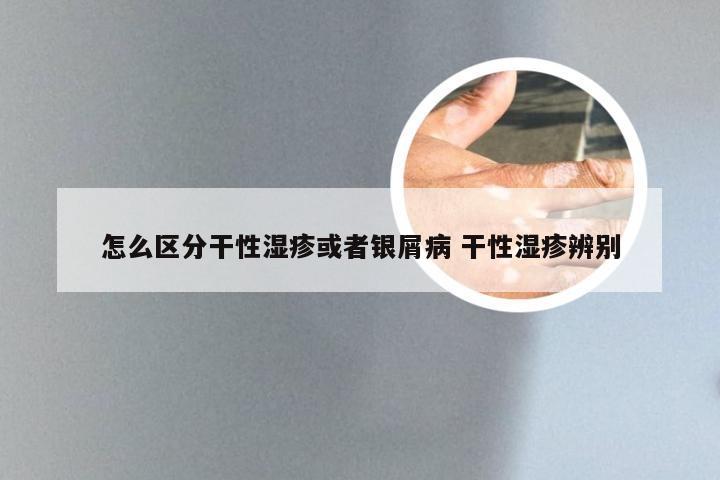 怎么区分干性湿疹或者银屑病 干性湿疹辨别