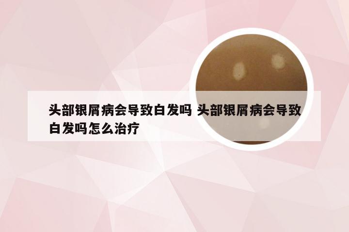 头部银屑病会导致白发吗 头部银屑病会导致白发吗怎么治疗