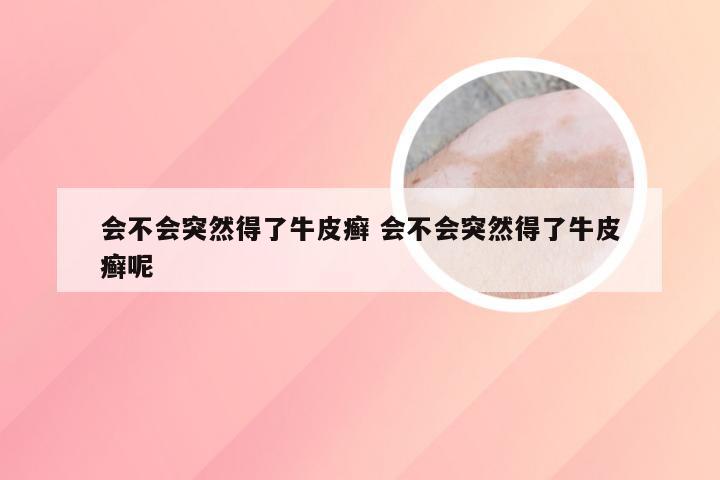会不会突然得了牛皮癣 会不会突然得了牛皮癣呢
