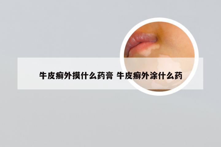 牛皮癣外摸什么药膏 牛皮癣外涂什么药