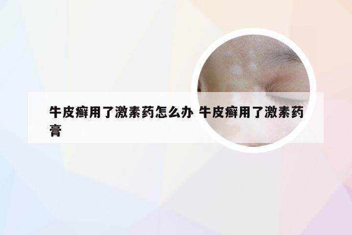 牛皮癣用了激素药怎么办 牛皮癣用了激素药膏