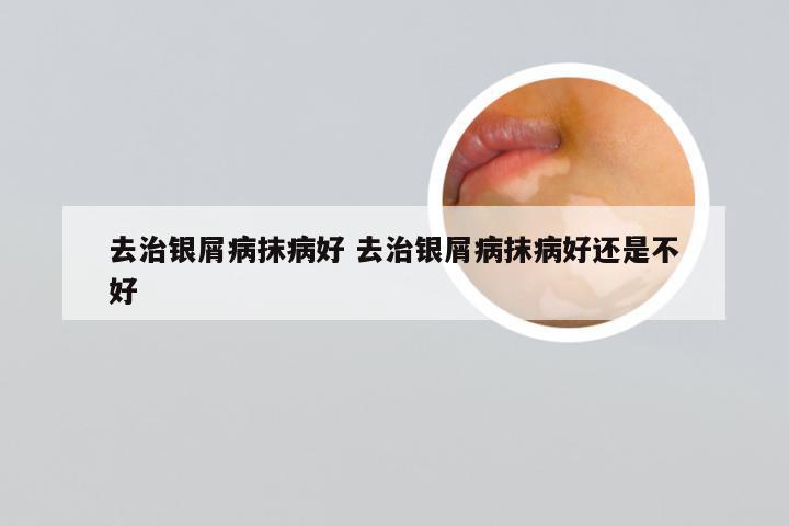 去治银屑病抹病好 去治银屑病抹病好还是不好