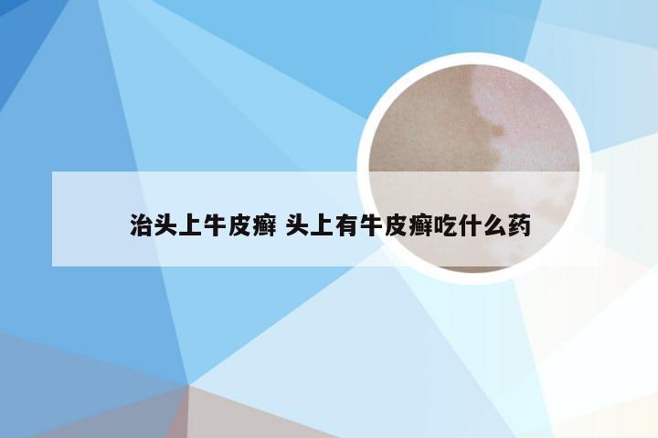 治头上牛皮癣 头上有牛皮癣吃什么药