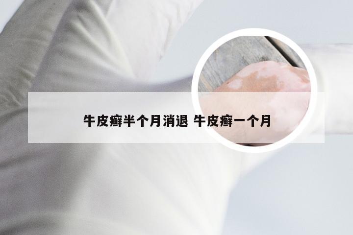 牛皮癣半个月消退 牛皮癣一个月