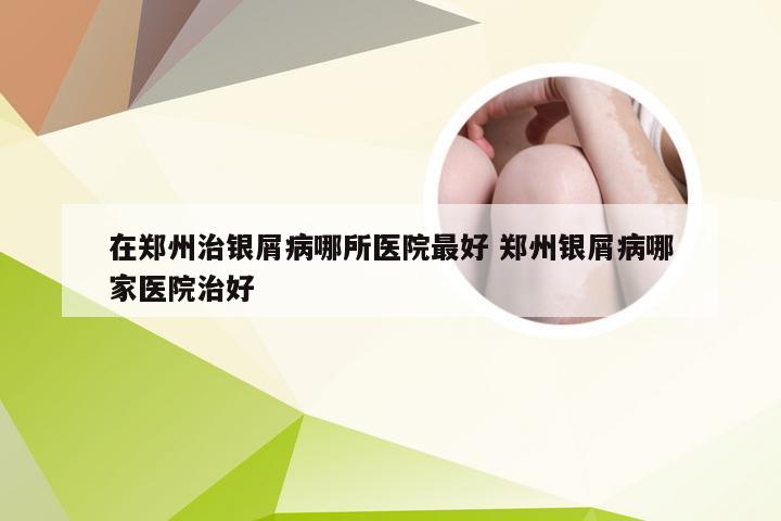 在郑州治银屑病哪所医院最好 郑州银屑病哪家医院治好