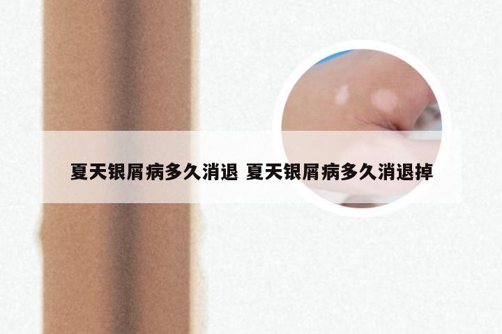 夏天银屑病多久消退 夏天银屑病多久消退掉