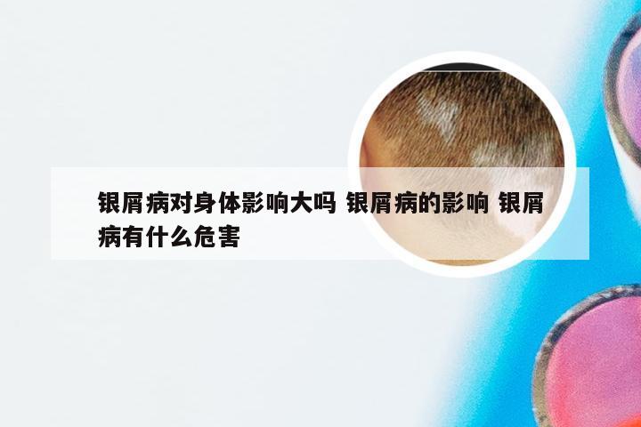银屑病对身体影响大吗 银屑病的影响 银屑病有什么危害