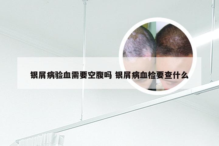 银屑病验血需要空腹吗 银屑病血检要查什么