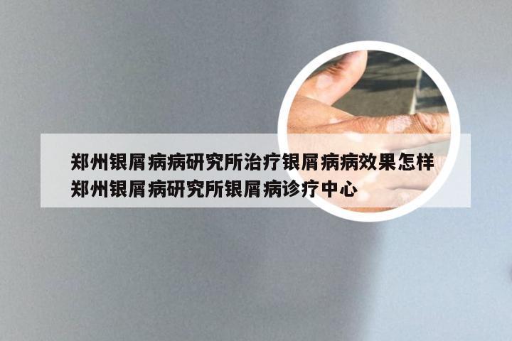 郑州银屑病病研究所治疗银屑病病效果怎样 郑州银屑病研究所银屑病诊疗中心