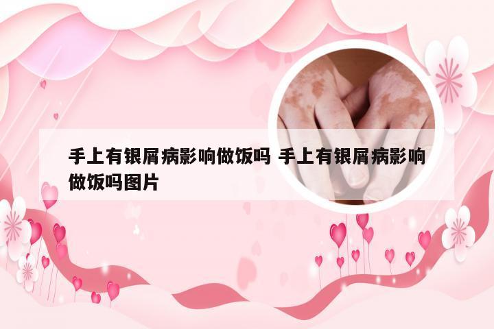 手上有银屑病影响做饭吗 手上有银屑病影响做饭吗图片