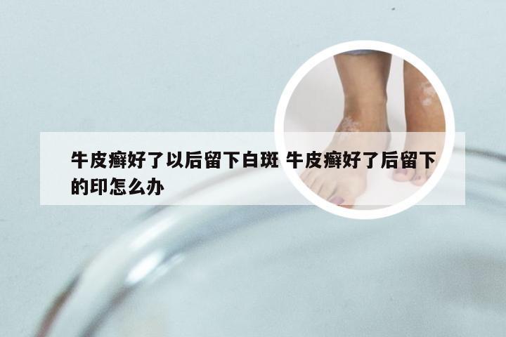 牛皮癣好了以后留下白斑 牛皮癣好了后留下的印怎么办