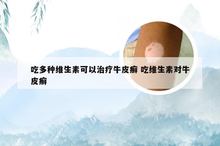 吃多种维生素可以治疗牛皮癣 吃维生素对牛皮癣