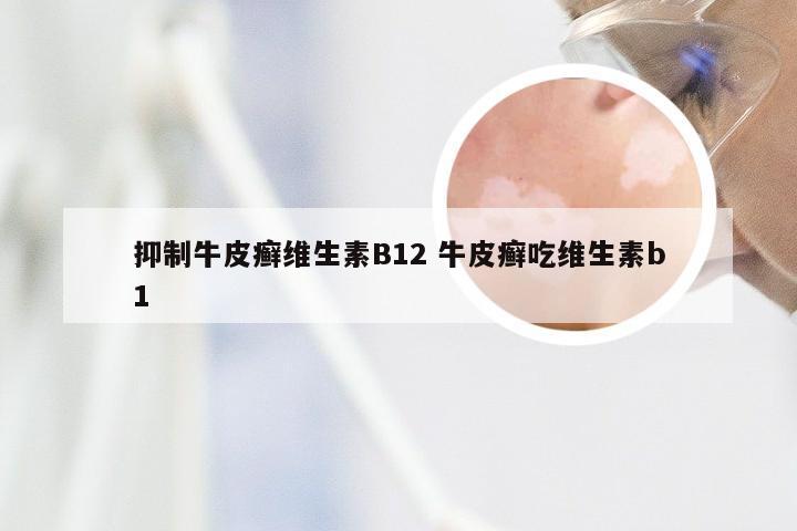 抑制牛皮癣维生素B12 牛皮癣吃维生素b1