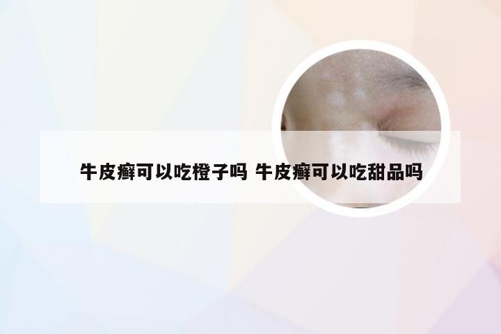 牛皮癣可以吃橙子吗 牛皮癣可以吃甜品吗