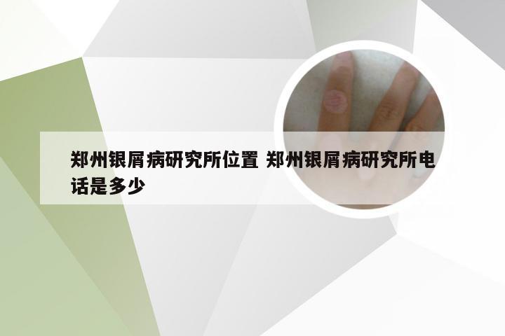 郑州银屑病研究所位置 郑州银屑病研究所电话是多少