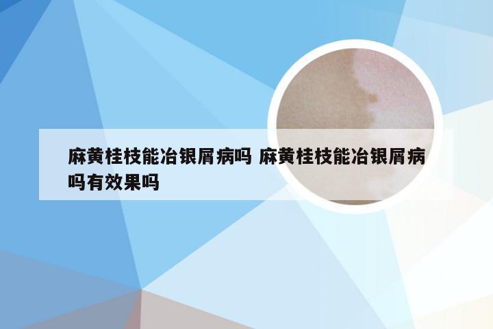 麻黄桂枝能冶银屑病吗 麻黄桂枝能冶银屑病吗有效果吗
