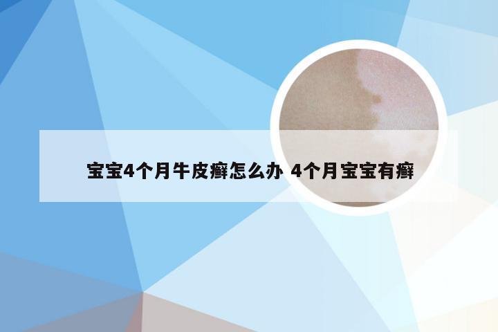 宝宝4个月牛皮癣怎么办 4个月宝宝有癣