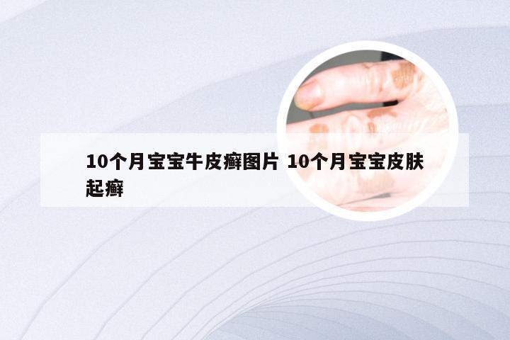 10个月宝宝牛皮癣图片 10个月宝宝皮肤起癣