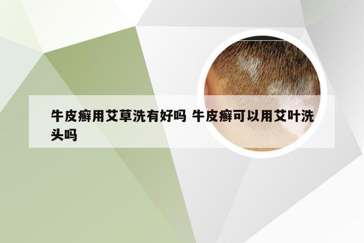 牛皮癣用艾草洗有好吗 牛皮癣可以用艾叶洗头吗