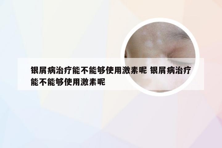 银屑病治疗能不能够使用激素呢 银屑病治疗能不能够使用激素呢