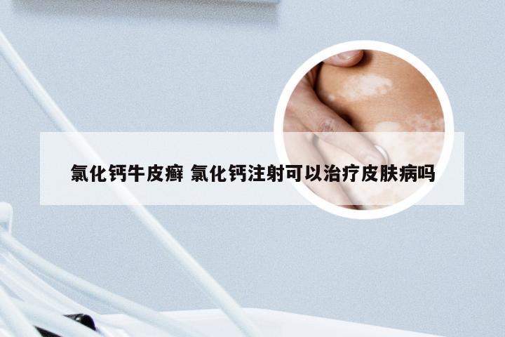 氯化钙牛皮癣 氯化钙注射可以治疗皮肤病吗