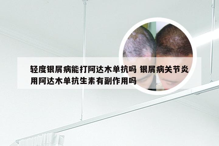 轻度银屑病能打阿达木单抗吗 银屑病关节炎用阿达木单抗生素有副作用吗
