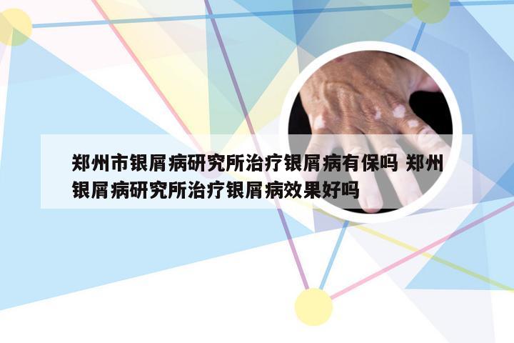 郑州市银屑病研究所治疗银屑病有保吗 郑州银屑病研究所治疗银屑病效果好吗