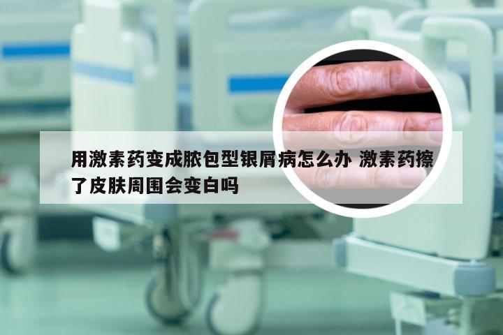 用激素药变成脓包型银屑病怎么办 激素药擦了皮肤周围会变白吗