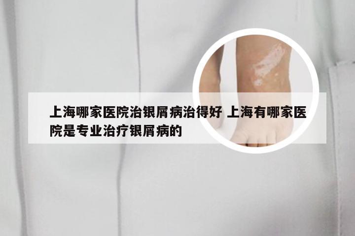 上海哪家医院治银屑病治得好 上海有哪家医院是专业治疗银屑病的