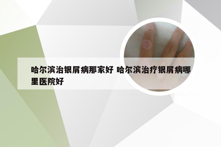 哈尔滨治银屑病那家好 哈尔滨治疗银屑病哪里医院好