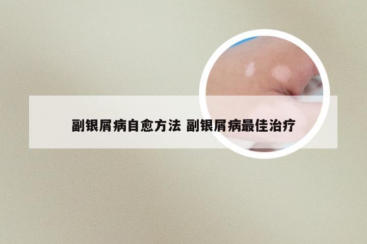 副银屑病自愈方法 副银屑病最佳治疗